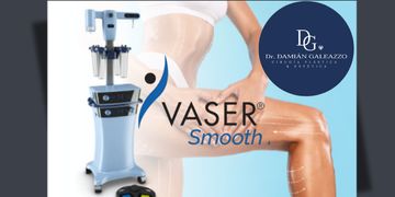 VASER Smooth: la tecnología que redefine el tratamiento de la celulitis y la calidad de la piel