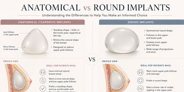 IMPLANTES MAMARIOS HOY: TODO LO QUE NECESITA SABER SOBRE LAS NUEVAS TENDENCIAS Y TECNOLOGÍAS IMPLANTES MAMARIOS HOY: TODO LO QUE NECESITA SABER SOBRE LAS NUEVAS TENDENCIAS Y TECNOLOGÍAS