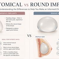 IMPLANTES MAMARIOS HOY: TODO LO QUE NECESITA SABER SOBRE LAS NUEVAS TENDENCIAS Y TECNOLOGÍAS