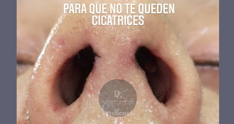 Rinoplastia sin cortes: naturalidad, precisión y una recuperación más armónica