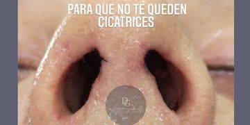 Rinoplastia sin cortes: naturalidad, precisión y una recuperación más armónica