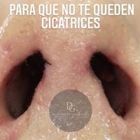 Rinoplastia sin cortes: naturalidad, precisión y una recuperación más armónica
