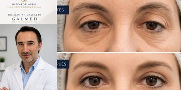 Blefaroplastia: cuándo es el momento de realizarla y cuándo los tratamientos inyectables pueden refrescar la mirada Blefaroplastia: cuándo es el momento de realizarla y cuándo los tratamientos inyectables pueden refrescar la mirada