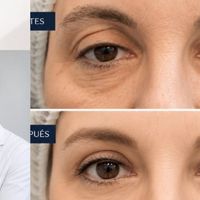 Blefaroplastia: cuándo es el momento de realizarla y cuándo los tratamientos inyectables pueden refrescar la mirada