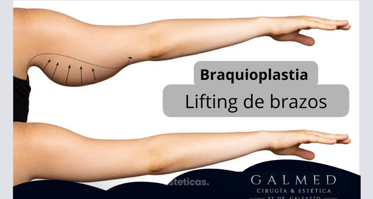 Braquioplastia: cuándo la cirugía de brazos es la solución para recuperar firmeza y armonía corporal