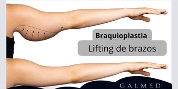 Braquioplastia: cuándo la cirugía de brazos es la solución para recuperar firmeza y armonía corporal Braquioplastia: cuándo la cirugía de brazos es la solución para recuperar firmeza y armonía corporal