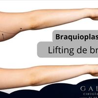 Braquioplastia: cuándo la cirugía de brazos es la solución para recuperar firmeza y armonía corporal