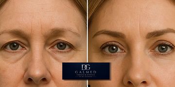 Bioestimuladores de colágeno: qué son, cómo funcionan y cuándo realizar este tratamiento de rejuvenecimiento facial