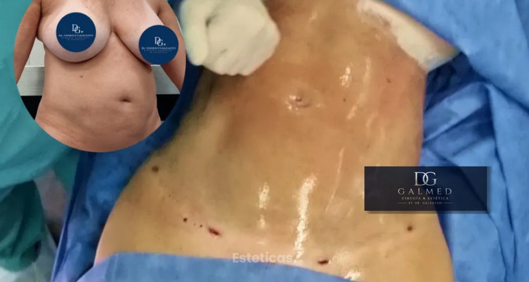Mini abdominoplastia: cuando menos cirugía puede ser la mejor decisión