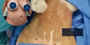 Mini abdominoplastia: cuando menos cirugía puede ser la mejor decisión Mini abdominoplastia: cuando menos cirugía puede ser la mejor decisión