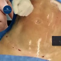 Mini abdominoplastia: cuando menos cirugía puede ser la mejor decisión