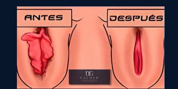 Cirugía íntima femenina: cuándo está indicada y qué cambios puede aportar en la calidad de vida Cirugía íntima femenina: cuándo está indicada y qué cambios puede aportar en la calidad de vida