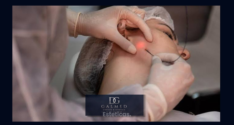 Endoláser: el tratamiento mínimamente invasivo que redefine el rostro y el cuerpo estimulando el colágeno