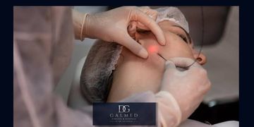 Endoláser: el tratamiento mínimamente invasivo que redefine el rostro y el cuerpo estimulando el colágeno