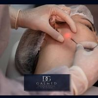 Endoláser: el tratamiento mínimamente invasivo que redefine el rostro y el cuerpo estimulando el colágeno