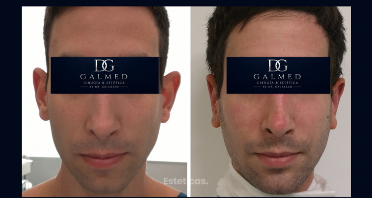 Otoplastia: la cirugía que puede transformar la armonía del rostro y la confianza personal