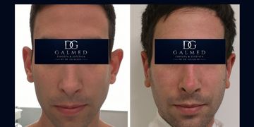 Otoplastia: la cirugía que puede transformar la armonía del rostro y la confianza personal