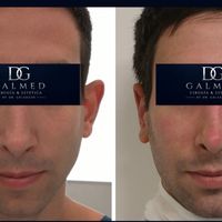 Otoplastia: la cirugía que puede transformar la armonía del rostro y la confianza personal