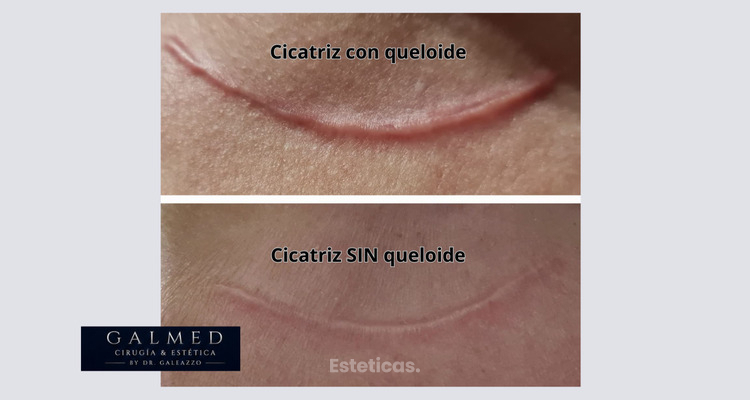Cicatrices queloides: cuando una herida sigue creciendo y afecta mucho más que la piel