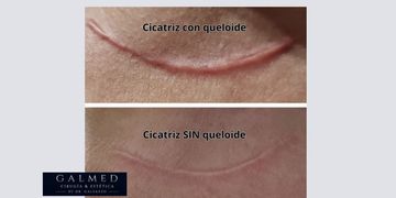 Cicatrices queloides: cuando una herida sigue creciendo y afecta mucho más que la piel