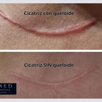 Cicatrices queloides: cuando una herida sigue creciendo y afecta mucho más que la piel