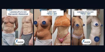 ¿Por qué VASER Smooth y Renuvion son una de las combinaciones más buscadas en cirugía corporal? ¿Por qué VASER Smooth y Renuvion son una de las combinaciones más buscadas en cirugía corporal?