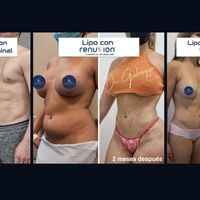 ¿Por qué VASER Smooth y Renuvion son una de las combinaciones más buscadas en cirugía corporal?