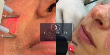 Láser CO₂ en invierno: por qué esta es la mejor época para rejuvenecer tu piel Láser CO₂ en invierno: por qué esta es la mejor época para rejuvenecer tu piel