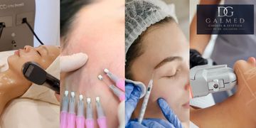 Lifting facial sin cirugía: tratamientos y a qué edad conviene Lifting facial sin cirugía: tratamientos y a qué edad conviene