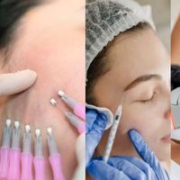 Lifting facial sin cirugía: tratamientos y a qué edad conviene