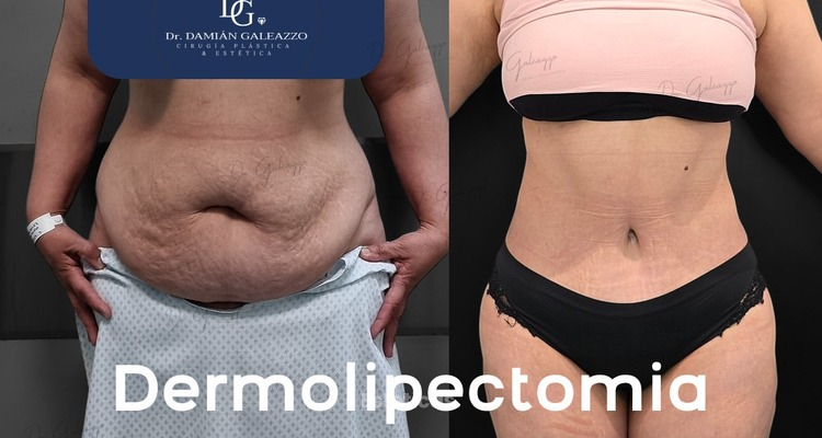 ¿Cuánto hay que esperar para hacerse una abdominoplastia después de un embarazo?