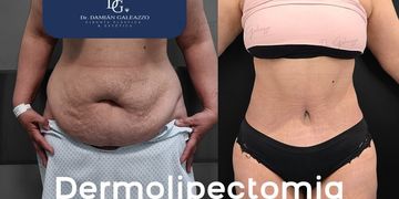 ¿Cuánto hay que esperar para hacerse una abdominoplastia después de un embarazo? ¿Cuánto hay que esperar para hacerse una abdominoplastia después de un embarazo?