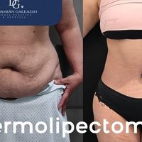 ¿Cuánto hay que esperar para hacerse una abdominoplastia después de un embarazo?