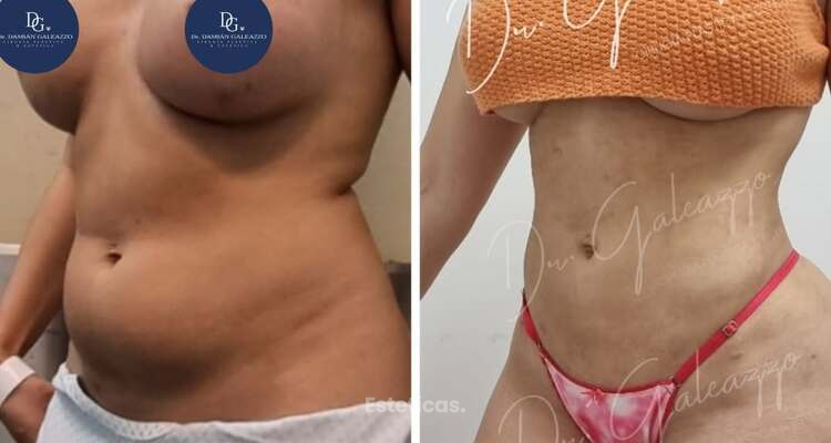 ¿Cuándo hacerse una lipoescultura después de un embarazo?