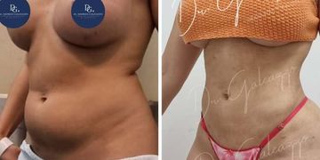 ¿Cuándo hacerse una lipoescultura después de un embarazo? ¿Cuándo hacerse una lipoescultura después de un embarazo?