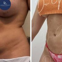 ¿Cuándo hacerse una lipoescultura después de un embarazo?