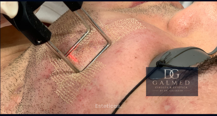Láser CO₂ para cicatrices de acné y manchas en la cara: el tratamiento que ayuda a recuperar una piel más uniforme