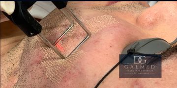 Láser CO₂ para cicatrices de acné y manchas en la cara: el tratamiento que ayuda a recuperar una piel más uniforme