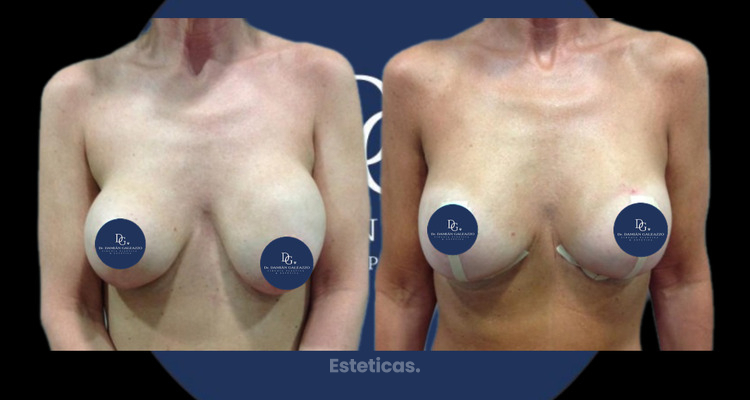 Podría tratarse de un encapsulamiento mamario si te pasan estas cosas