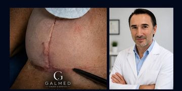 Cicatrices del aumento mamario: dónde se hacen las incisiones y cuál es la mejor opción Cicatrices del aumento mamario: dónde se hacen las incisiones y cuál es la mejor opción