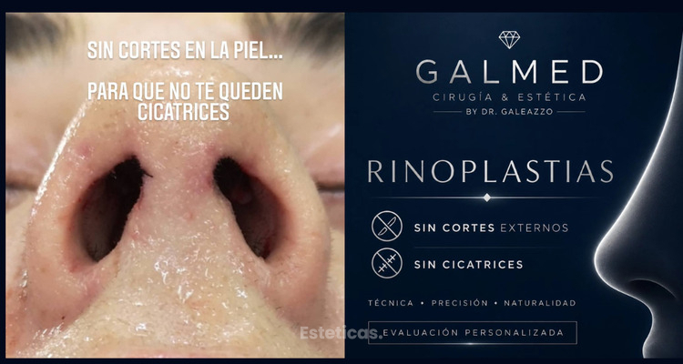 Cicatrices de la rinoplastia: la técnica sin cicatrices visibles que transforma la experiencia de muchos pacientes