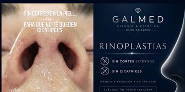 Cicatrices de la rinoplastia: la técnica sin cicatrices visibles que transforma la experiencia de muchos pacientes