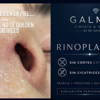 Cicatrices de la rinoplastia: la técnica sin cicatrices visibles que transforma la experiencia de muchos pacientes