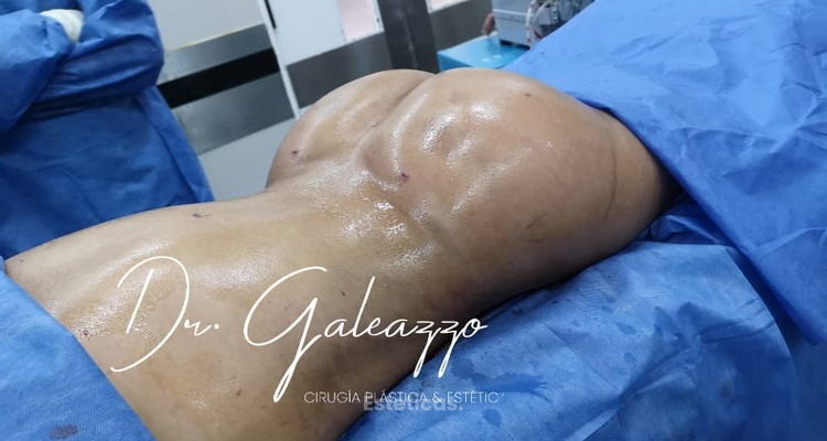 Gluteoplastia: todo lo que necesitás saber para lograr un resultado natural y armónico