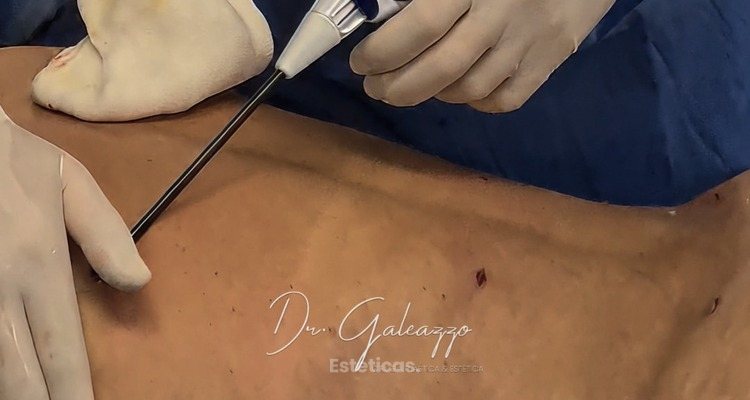 ¿Qué tecnologías se utilizan en una lipoescultura moderna?