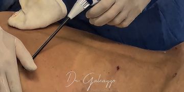 ¿Qué tecnologías se utilizan en una lipoescultura moderna? ¿Qué tecnologías se utilizan en una lipoescultura moderna?