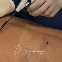 ¿Qué tecnologías se utilizan en una lipoescultura moderna?