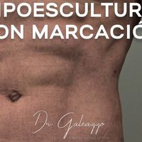 ¿Qué evalúa el Dr. Galeazzo antes de indicar una cirugía?