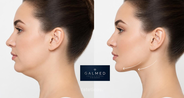 ¿Con qué se puede combinar la lipopapada? Endolaser, HIFU y rellenos