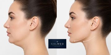 ¿Con qué se puede combinar la lipopapada? Endolaser, HIFU y rellenos ¿Con qué se puede combinar la lipopapada? Endolaser, HIFU y rellenos